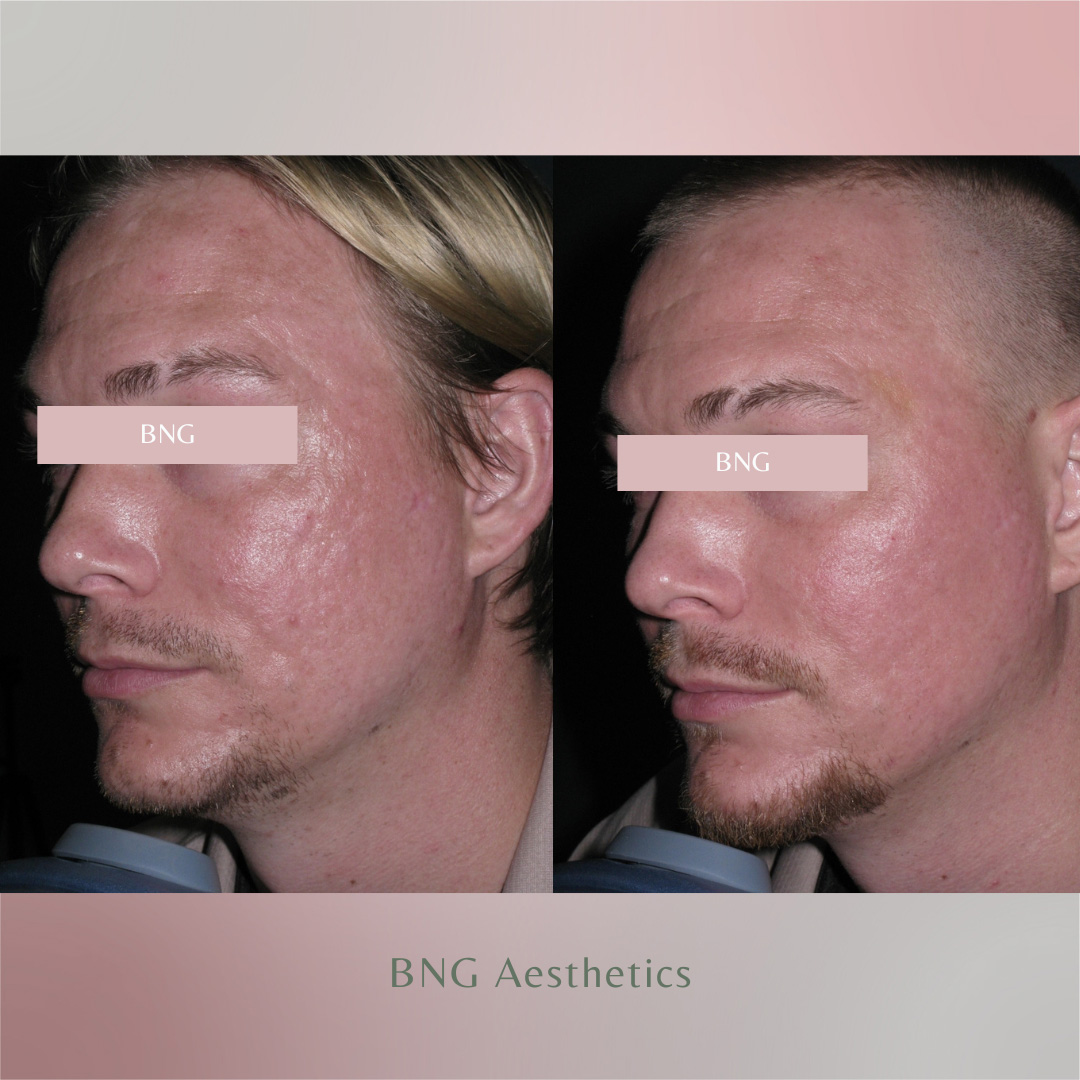 Bellafill BNG Aesthetics Skin & Laser Center