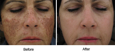 Forever Young BBL Skin Rejuvenation Results