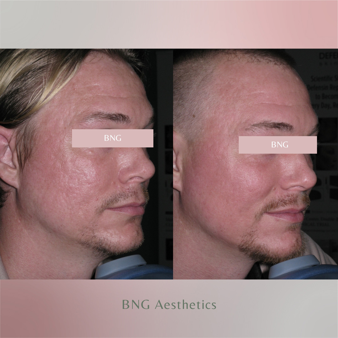 Bellafill BNG Aesthetics Skin & Laser Center