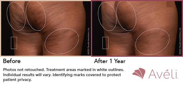Cellulite Reduction before and after 1