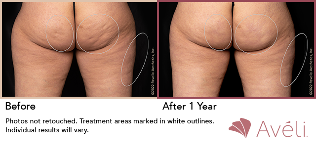 Cellulite Reduction before and after 2