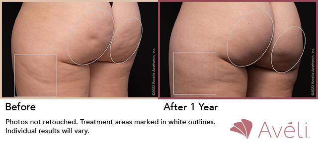 Cellulite Reduction before and after 3