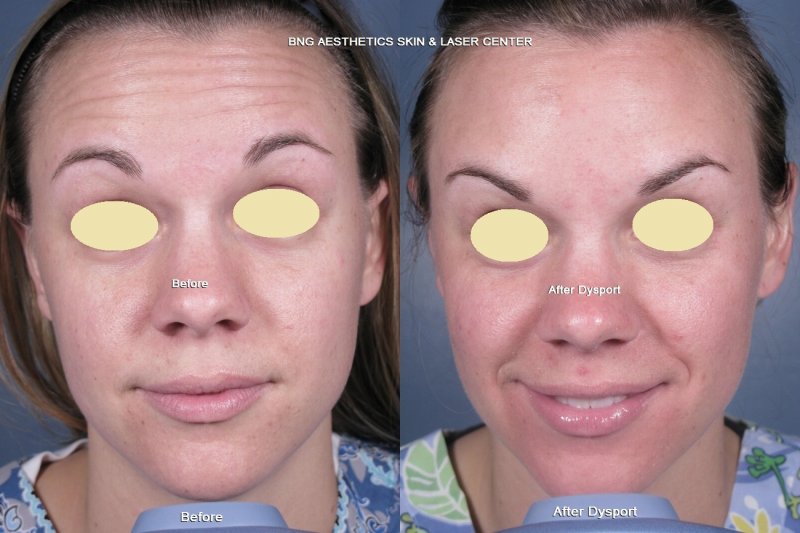 Dysport BNG Aesthetics Skin & Laser Center