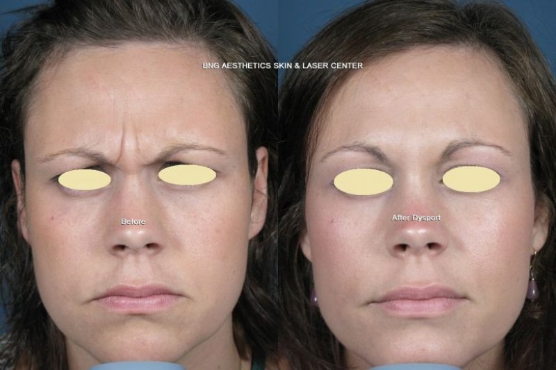 Dysport BNG Aesthetics Skin & Laser Center