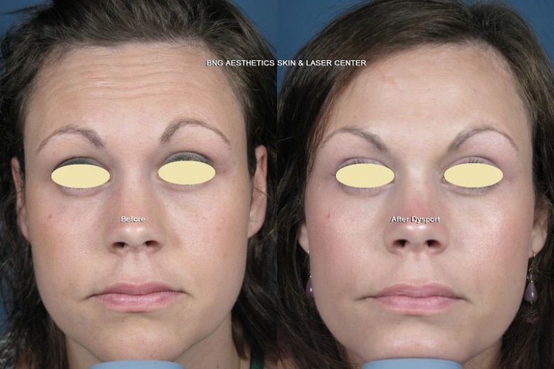 Dysport BNG Aesthetics Skin & Laser Center