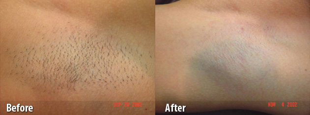 Laser Hair Removal Williamsport PA | BNG Aesthetics Skin & Laser Center