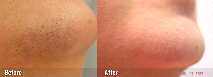 Laser Hair Removal Results on Chin