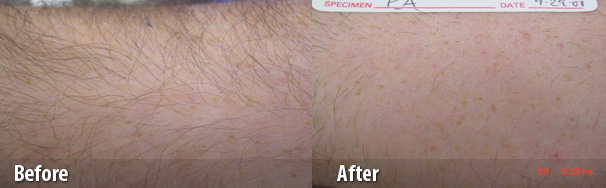 Laser Hair Removal Results