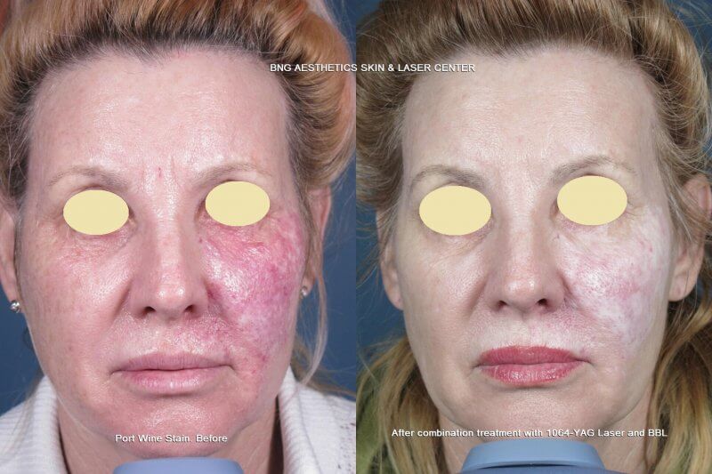Port Wine Stain Treatment BNG Aesthetics Skin & Laser Center