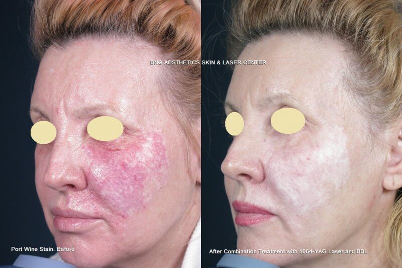 Port Wine Stain Treatment BNG Aesthetics Skin & Laser Center
