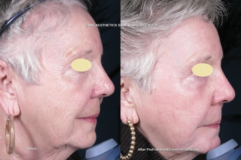 Profractional Laser Resurfacing BNG Aesthetics Skin & Laser Center