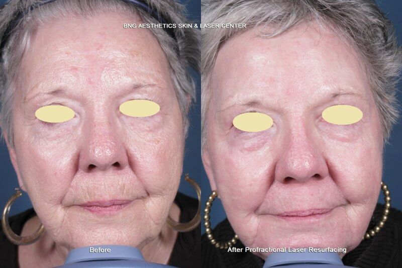 Profractional Laser Resurfacing BNG Aesthetics Skin & Laser Center