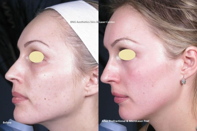 Profractional & MLP BNG Aesthetics Skin & Laser Center