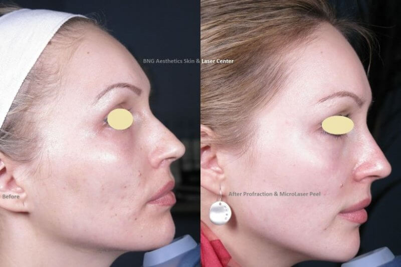  Profractional & MLP BNG Aesthetics Skin & Laser Center