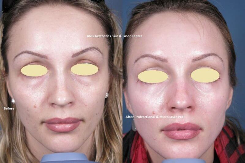 Profractional & MLP BNG Aesthetics Skin & Laser Center