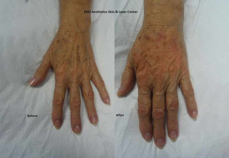 Radiesse Hand Augmentation BNG Aesthetics Skin & Laser Center