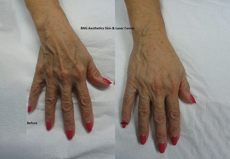 Radiesse Hand Augmentation BNG Aesthetics Skin & Laser Center