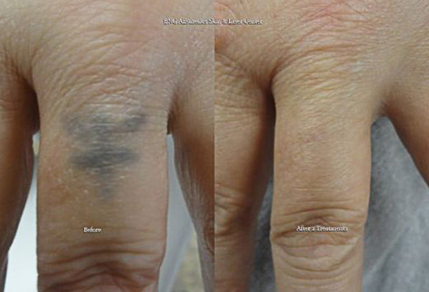 Tattoo Removal BNG Aesthetics Skin & Laser Center