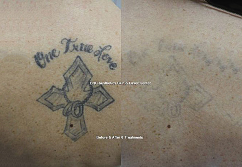 Tattoo Removal BNG Aesthetics Skin & Laser Center