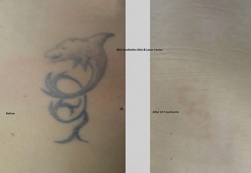 Tattoo Removal BNG Aesthetics Skin & Laser Center