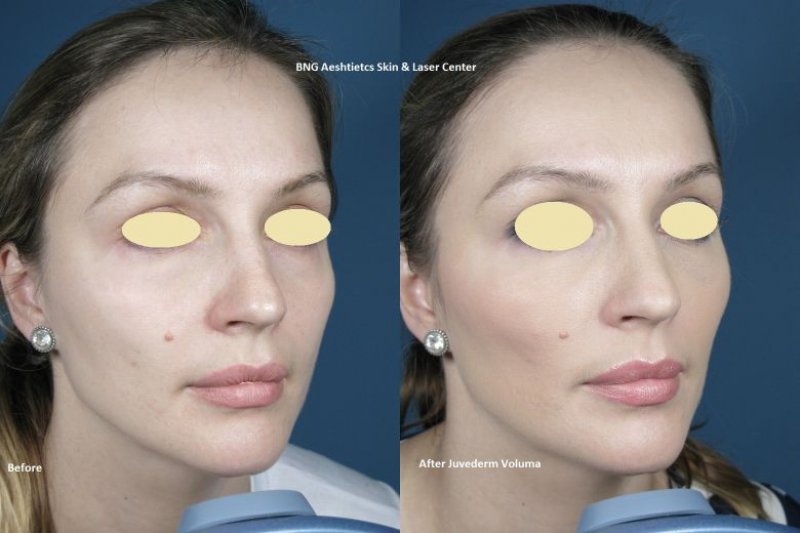 Voluma BNG Aesthetics Skin & Laser Center