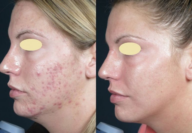 ZO Treatment BNG Aesthetics Skin & Laser Center