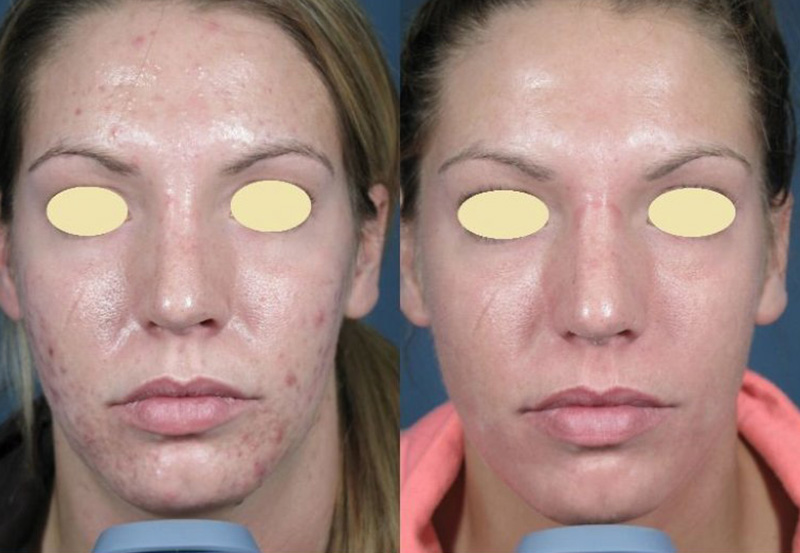 ZO Treatment BNG Aesthetics Skin & Laser Center
