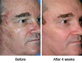 Laser Peel Williamsport PA Non Surgical Micro Laser Peel