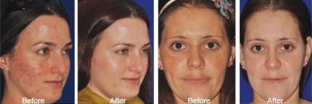 SkinPen Microneedling Results