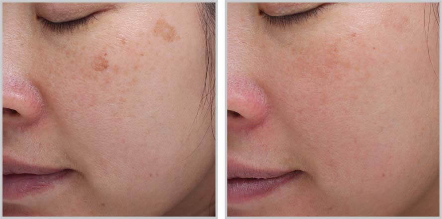 Moxi + BBL before and after