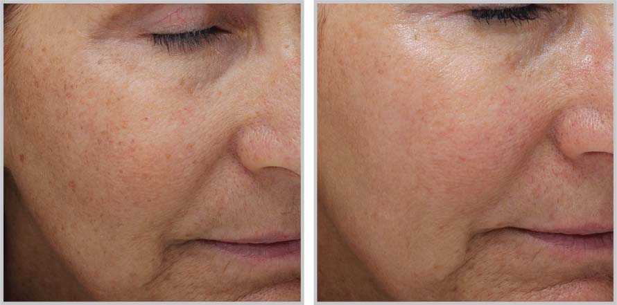 Moxi + BBL before and after