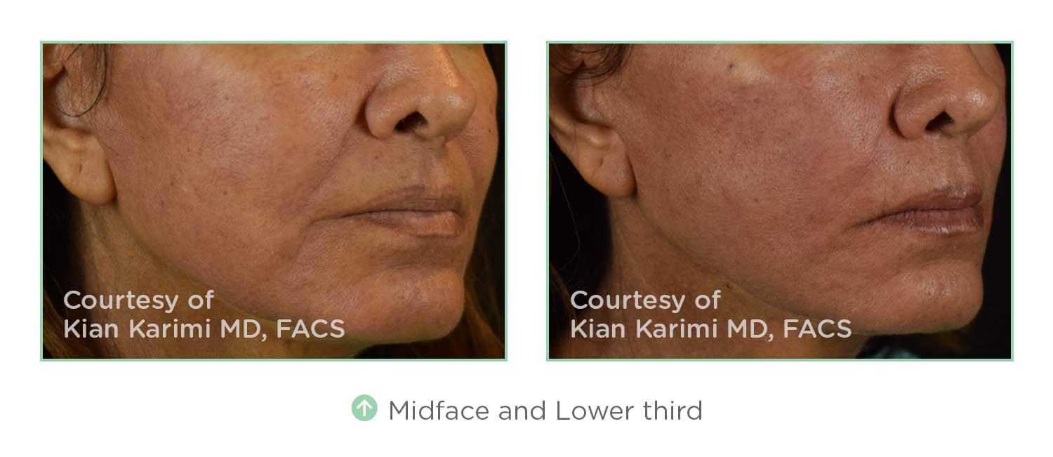 Thread Lift Results on Face