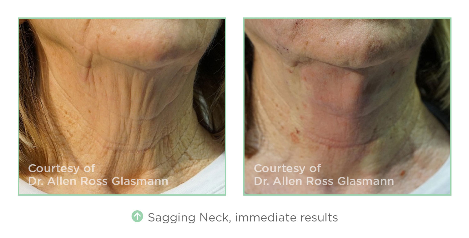 Thread Lift Results on Sagging Neck