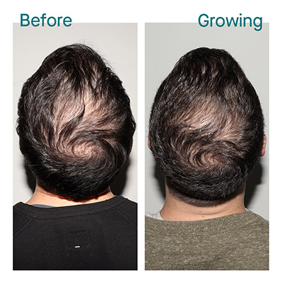 Nutrafol before and after male