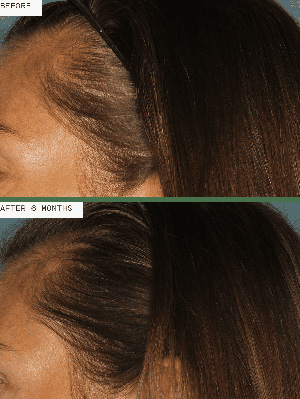Nutrafol before and after female