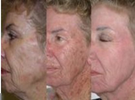 Photodynamic Therapy Results