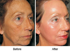 Profractional Laser Treatment Results