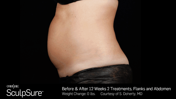 SculpSure Results