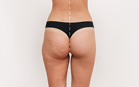 Cellulite Reduction Procedure Williamsport PA