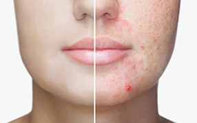Acne Large Pores & Oily Skin