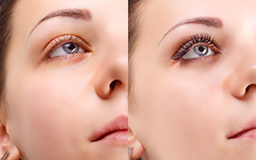 Thin Eyelashes Treatment with Latisse