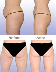 Smartlipo Results