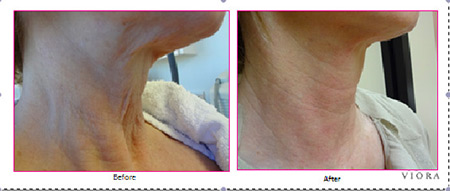 Viora Skin Tightening Results on Neck